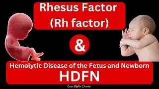 Rhesus Disease and HDFN