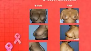 Breast Lifts and Reductions