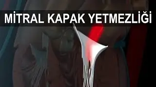 Mitrak Kapak Yetmezliği