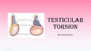 Testicular torsion - risk factors, clinical features, investigations, treatment, complications