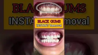 BLACK GUMS Instant Removal: Laser Depigmentation: Dr. Srishti Bhatia 