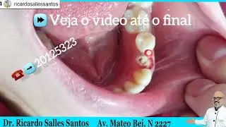 Dente com pino é bom?