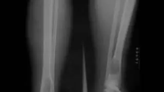 Nonossifying fibroma