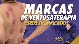 CUPPING THERAPY BRANDS AND THEIR MEANINGS - ATTENTION