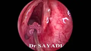papillomatose de la commissure postérieure du larynx traitement laser
