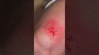 We made a Chemical Reaction on a BLOODY WOUND... 