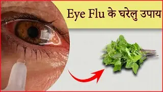 Eye Flu के घरेलु उपाय !! eye flu hone par kya karen !! eye flue home treatment in hindi !!