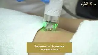 RF лифтинг живота в клинике Gold Laser