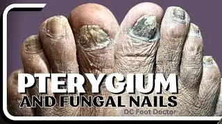 Pterygium and Fungal Toenails