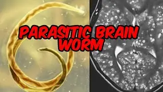 New parasitic brain worm found in Atlanta