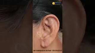 Ear Lobe Repair / Ear Holl Repair / Torn Ear Repair / Ear Pasting Lotion Available Call - 9687889595