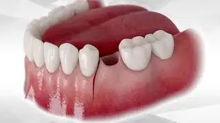 Bond Apatite protocol for socket grafting With Flap reflection