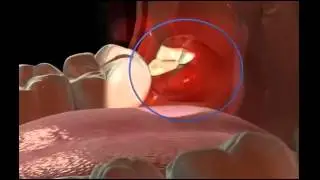 Wisdom Tooth Problems - Miskin Ajax Dental