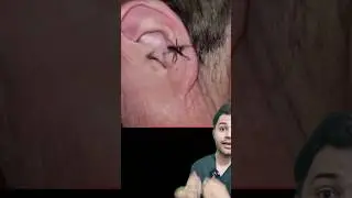 lidocaine 2% nightmare of insects!