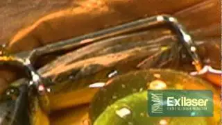 CROSSLINKING CORNEAL