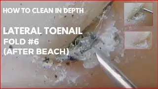 How to clean in depth lateral toenail fold #6 (After beach)
