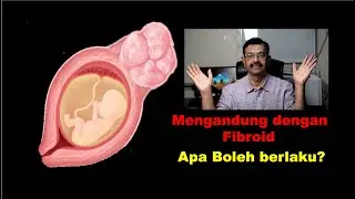 Mengandung dengan fibroid - 