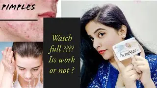 Acnestarsoap || acneproblemsolve ? || pimples ||honestReview ||  supriyatheclassytips