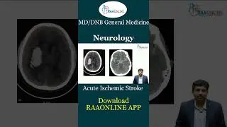 Acute Ischemic Stroke