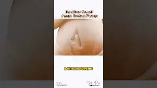 Melahirkan dengan Bantuan Forceps #edukasikehamilan #melahirkannormal #persalinandenganforceps