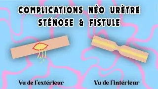 Complications phalloplastie néo urètre fistule & sténose // Ftm transgenre français // CRAZYDEN !