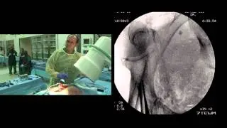 Lumbo-Pelvic Fixation Insertion Technique by Thomas A. Schildhauer, M.D.