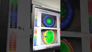 Paso a paso para realizarte una cirugía láser 👁️👁️✨