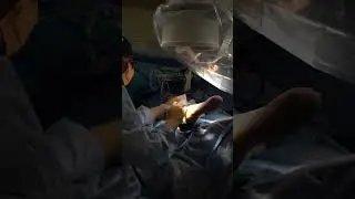 Ankle Fracture and Syndesmosis repair with arthroscopy