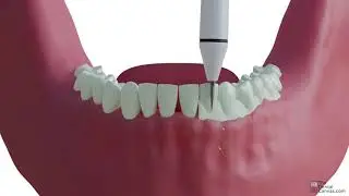 Scaling | Dental Procedures