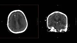 Neuroradiology Call Prep Cases: Acute Subdural Hematoma (CT) Case 8 Discussion