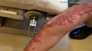 Considering PDL for Post Burn Keloid Scars? Watch This! #lasertreatment  #burnscar