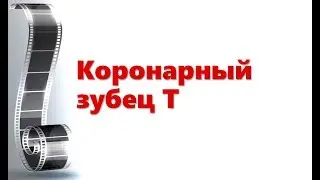 Коронарный зубец Т