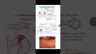 Waterhouse Friderichsen syndrome