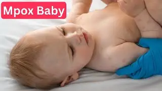 Mpox Baby Symptoms ECOSAM® #mpox #ecosam