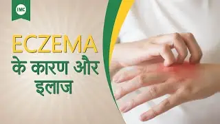 Skin Allergy Causes & Symptoms || Ayurvedic Treatment of Eczema in Hindi