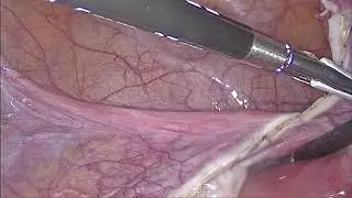 Salpingectomía de oportunidad laparoscópica con Enseal