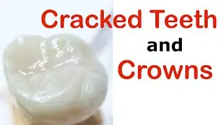 Treating Cracked Teeth with Composite Bonded Fillings and Crowns