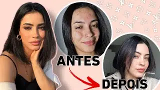 POMADA que TIROU todas minhas MANCHAS de ESPINHAS RÁPIDO!