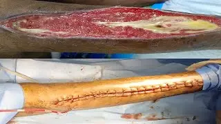 Post fasciotomy raw area| Wound closure| secondary suturing| Dr. Pandiaraja