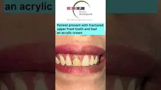 FRONT Teeth Smile Makeover with Zirconia Crown: Dr. Srishti Bhatia #smilemakeover #smile #zirconia