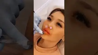 Увеличение губ. Результат в конце.