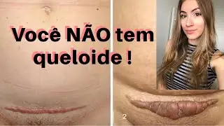 Queloide e Cicatriz hipertrófica entenda a diferença - por Larissa Costa