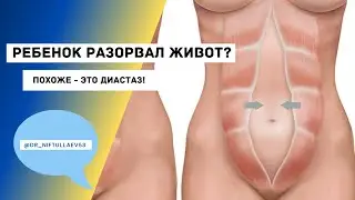 Диастаз или расхождение мышц живота