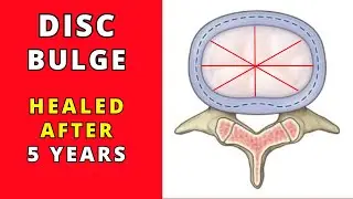 Lumbar disc bulge recovery after 5 years