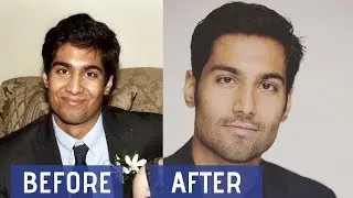 How Tongue Posture Affects Facial Bone Structure and Jawline (Mewing)