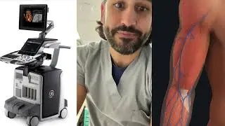 Unilateral Absence of the Cephalic Vein
