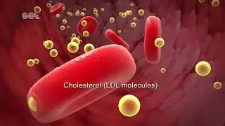 Arteriosclerosis