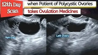 Ovarian CYSTS -  Ovulation Medicines in PCOS Patient ( Polycystic Ovaries ) Infertility