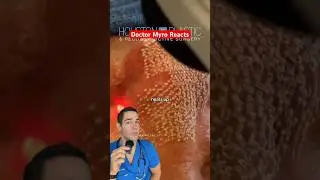 Doctor Reacts to laser skin treatment