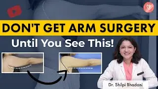 Arm Surgery Before and After | Arm Fat Removal | Flabby Arm | Arm Contouring | SB Aesthetics